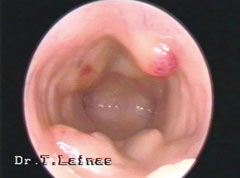 Polypoid hyperplasia of the endometrium (hysteroscopic image).